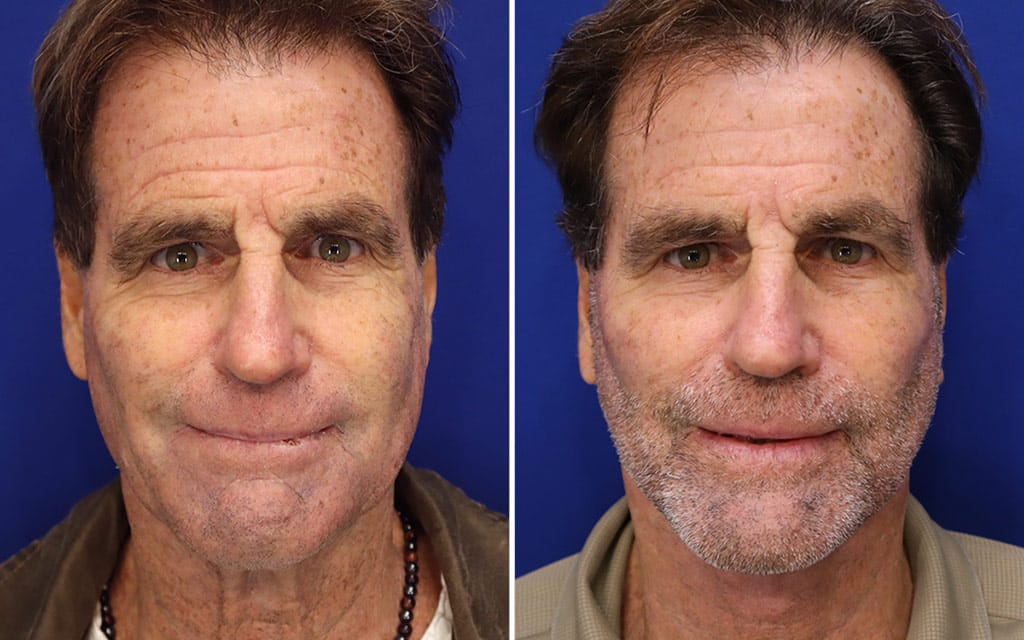Facelift Patient 8