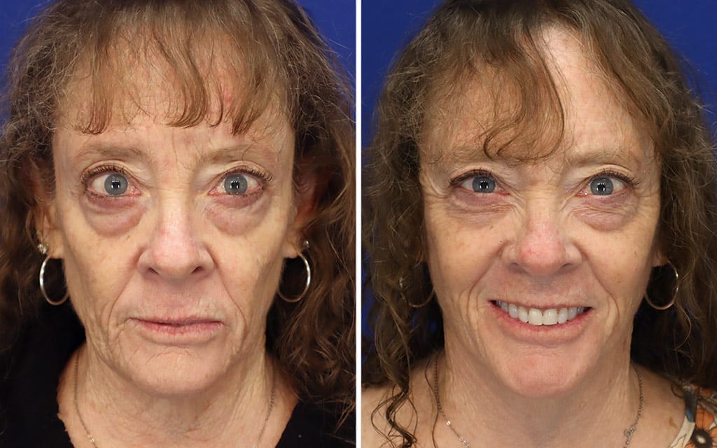 Facelift Patient 9