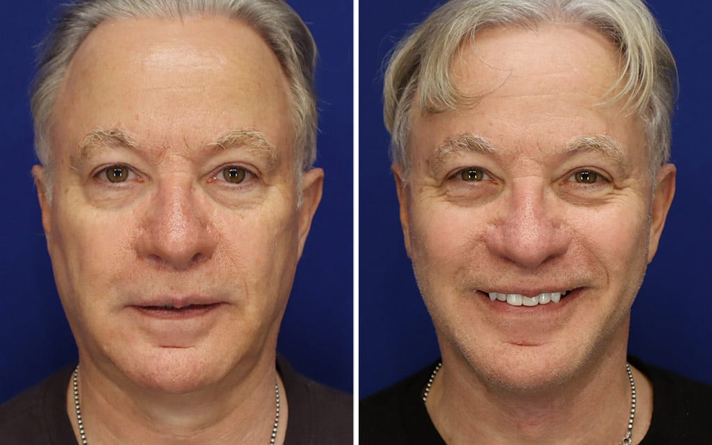 Facelift Patient 10