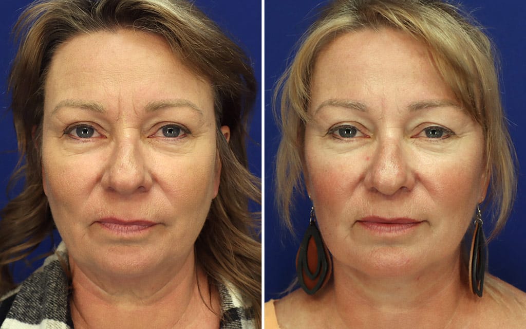 Facelift Patient 11